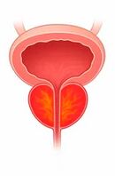 Inflamația glandei prostatei